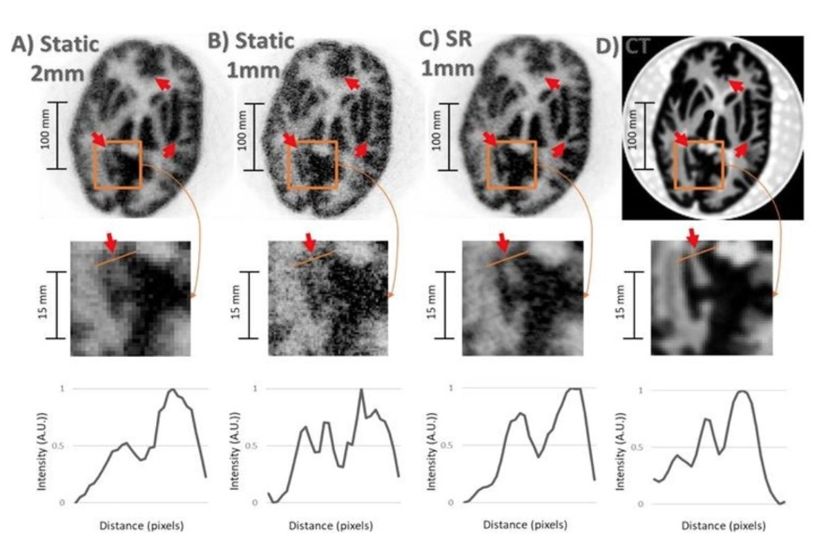 New superresolution technique enables more detailed brain imaging