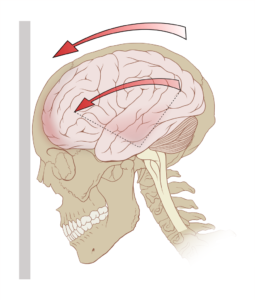 why females are more prone to concussions 