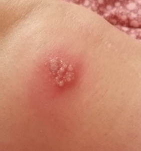 herpes infection