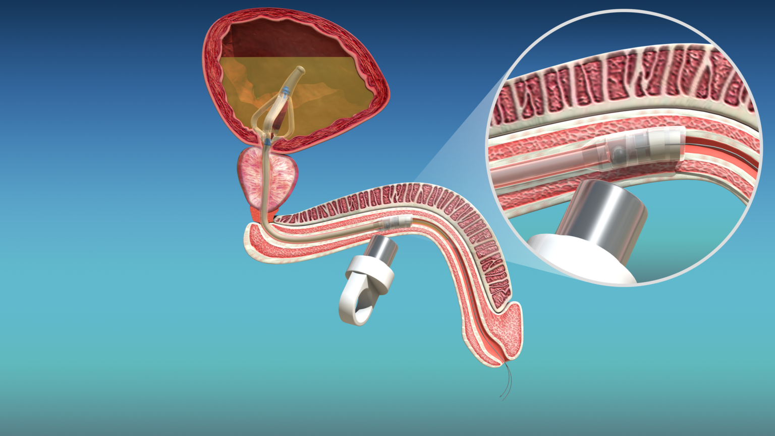 New catheter aims to reduce catheter-associated UTIs and improve ...
