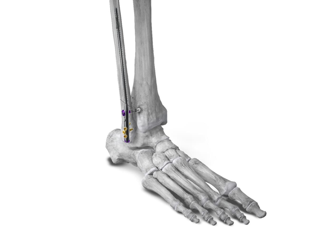 Paragon 28 introduces intramedullary nail system for fibular fracture repair