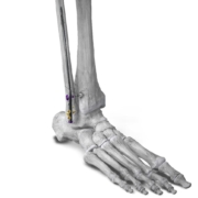 Paragon 28 introduces intramedullary nail system for fibular fracture repair