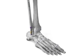 Paragon 28 introduces intramedullary nail system for fibular fracture repair