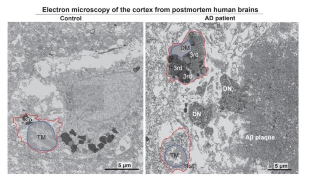 Electron micrographs show typical microglia in the prefrontal cortex of a 92-year-old healthy female (left) and dark microglia a 91-year-old female patient with Alzheimer’s disease (right)