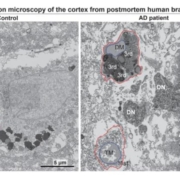 Electron micrographs show typical microglia in the prefrontal cortex of a 92-year-old healthy female (left) and dark microglia a 91-year-old female patient with Alzheimer’s disease (right)