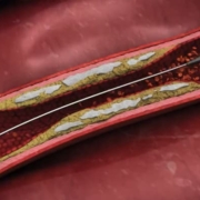 Elixir Medical has launched its LithiX Hertz Contact (HC) Intravascular Lithotripsy System (IVL) in Europe