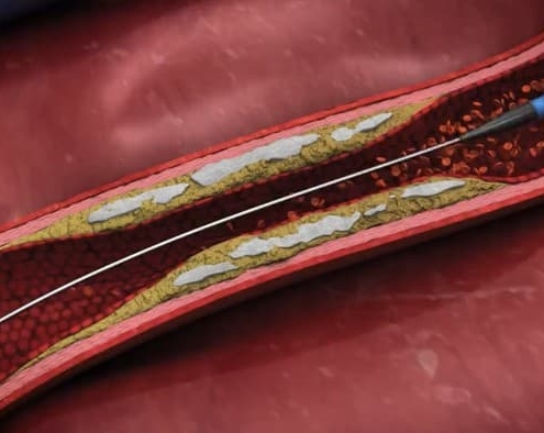 Elixir Medical has launched its LithiX Hertz Contact (HC) Intravascular Lithotripsy System (IVL) in Europe