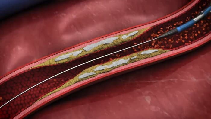 Elixir Medical has launched its LithiX Hertz Contact (HC) Intravascular Lithotripsy System (IVL) in Europe 