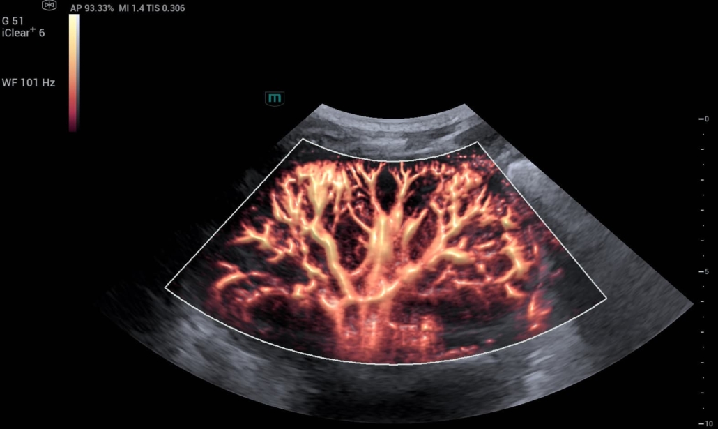 native kidney ultrasound