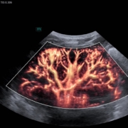 native kidney ultrasound