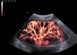 native kidney ultrasound