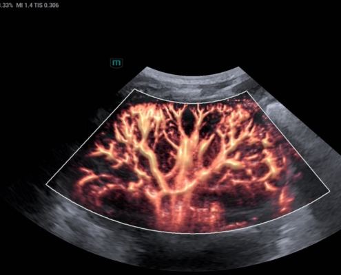 native kidney ultrasound