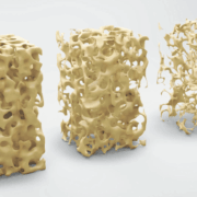 osteoporosis