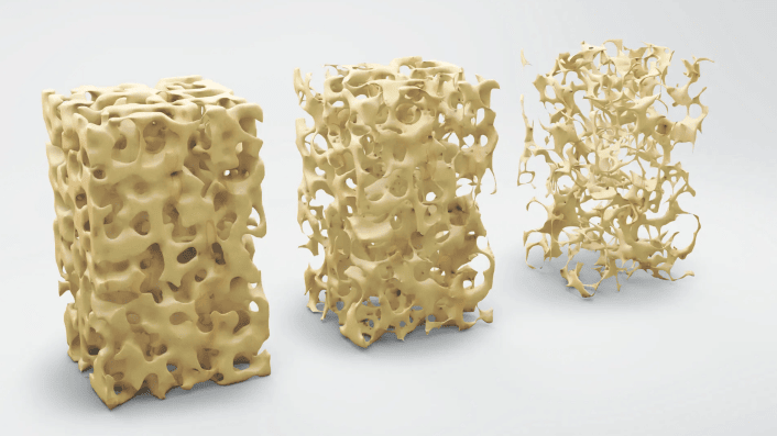 osteoporosis 
