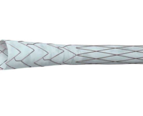 : Phraxis completes first commercial EndoForce anastomotic connector procedure at Spartanburg Regional, marking new era in dialysis vascular access technology.