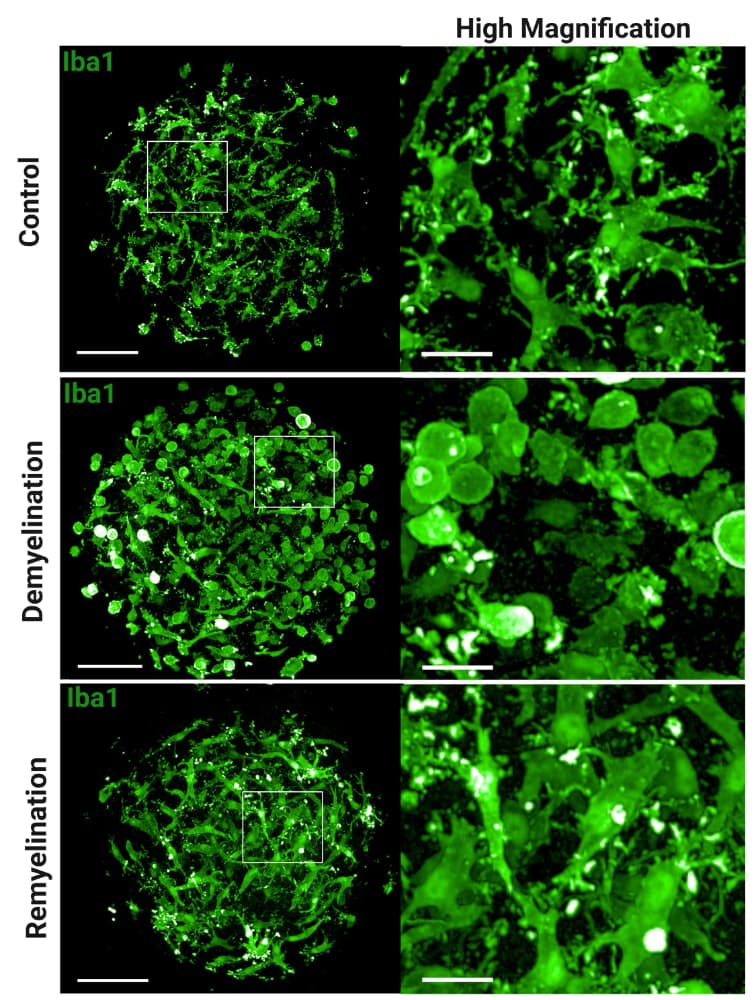 Microglia integrated in human brain organoids respond to toxin-induced demyelination with morphological changes. Representative immunofluorescence images show microglia (IBA1, green) in a human brain organoid model. Panels show the response to control conditions, demyelination (induced by toxin), and remyelination, respectively. Magnified insets an the right highlight the detailed morphological changes of microglia in each condition.