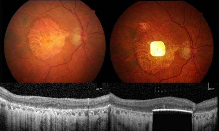 Image of the chip in a patient’s eye